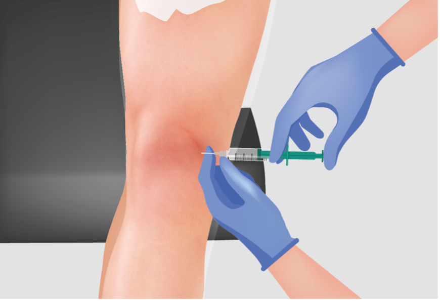 Knee injection treatment illustration